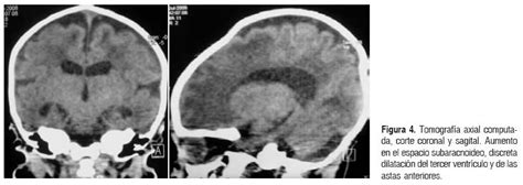 Lactante con atrofia muscular espinal y encefalopatía hipóxico isquémica