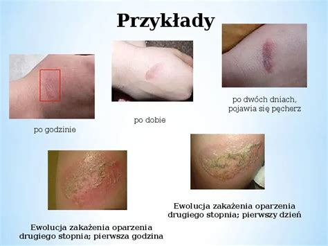 Prezentacja choroby i higiena skóry Świat prezentacji