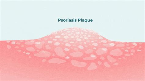 Pathophysiology of Psoriasis | Engaging Psoriatic Disease