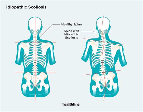 Idiopathic Scoliosis What You You Need To Know