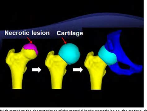 Figure 2 From Finite Element Analysis Of Osteonecrosis Of The Femoral