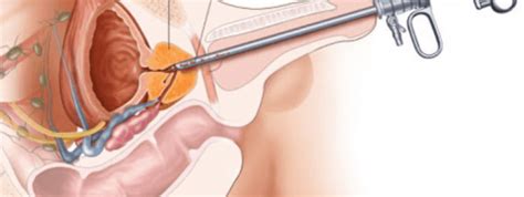 Resecci N Transuretral De Vejiga Lo Que Necesitas Saber