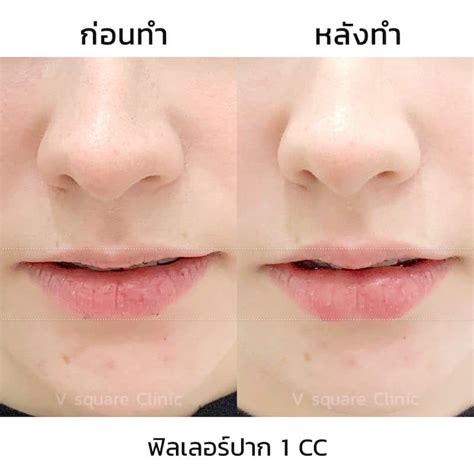 รีวิวฉีดฟิลเลอร์ปาก กระจับ เป็นทรง ปากสวยละมุนเป็นธรรมชาติ ไม่เป็นก้อน