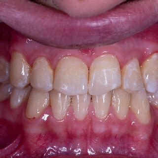 The Post Orthodontic White Spot Lesions Began To Fade And Become Less