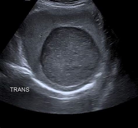 Splenic Epidermoid Cysts Image