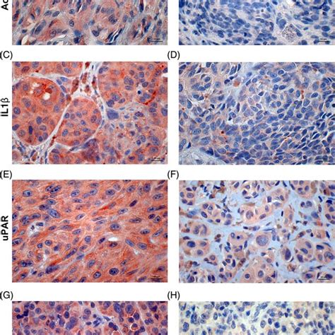 Immunohistochemical Staining Of Candidate Proteins In Tumour Cells A