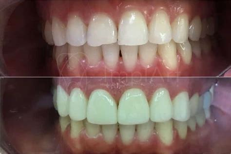 Lente Contato Dental Antes E Depois Implart