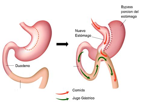 Minibypass Gástrico Cirugía De Obesidad Monterrey