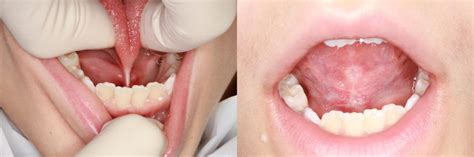 Labial Frenectomy Before And After