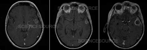 Photograph | Radiation therapy, MRI | Science Source Images