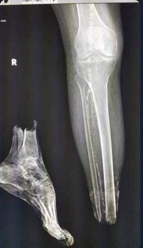 Fuck R Neverbrokeabone