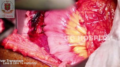 Hepaticojejunostomy For Bile Duct Stricture Youtube