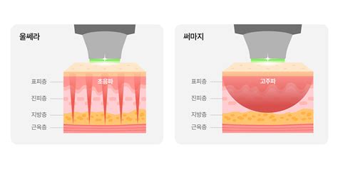 V라인 리프팅 울쎄라 Vs 써마지 어떤 게 나을까