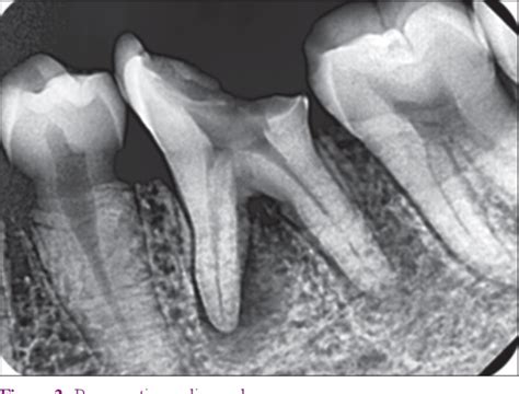 Figure 2 From Bone Regeneration On Chronic Apical Abscess After Root Canal Treatment On Left