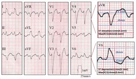 ECG from a patient with acute myocardial infarction and culprit lesion... | Download Scientific ...