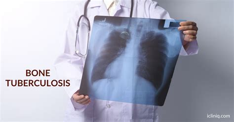 Know How Our iCliniq Doctor Helped a Patient With Bone Tuberculosis (TB)