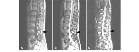 A C Sagittal A T Weighted And B T Weighted Mr Images Show A