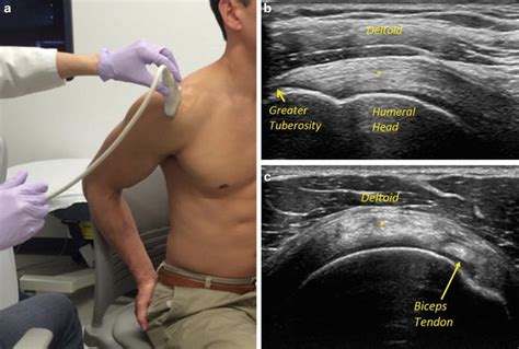 Ultrasound In Rotator Cuff Evaluation Springerlink