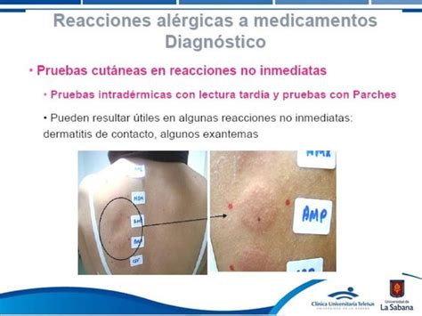 Reacciones Alergicas A Los Medicamentos PPT