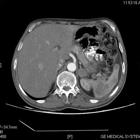 Ct Scan Abdomen Showing Enlarged Lymph Nodes And Splenic Lesions Download High Resolution