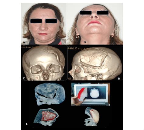 A And B Preoperative Frontal View Of Patient With Download Scientific Diagram