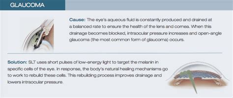 Fort Myers Glaucoma Slt Snead Eye Group Schedule An Appointment