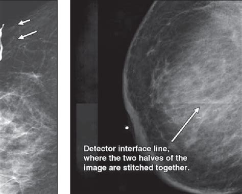 Figure 1 From Challenges In Mammography Part 1 Artifacts In Digital