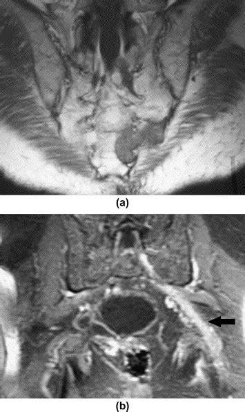 Causes Of Lumbosacral Plexopathy Clinical Radiology