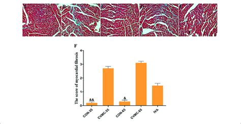 Myocardial Fibrosis In The Heart Masson S Trichrome Stain High