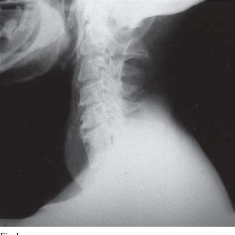 Figure 1 From Osteomielite Na Coluna Vertebral Relacionada Com Infecção