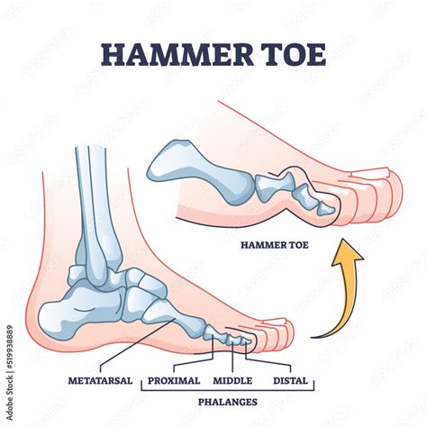 Hammer Toe Medical Problem Anatomy With Foot Phalanges Deformation