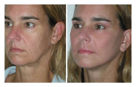 Aptos Aptos Thread Lift Sydney Thread Mini Face Lift Dr Beaini