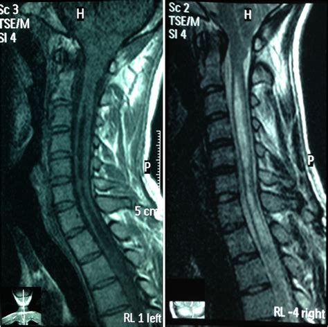 Dissociated Sensory Loss And Muscle Wasting In A Young Male With