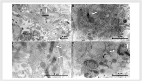 Electron Microscopy Of Endomyocardial Biopsy EMB Specimens In