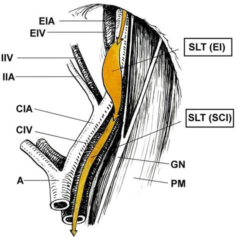 Pdf TÉcnica De La LinfadenectomÍa PÉlvica Y ParaaÓrtica En El