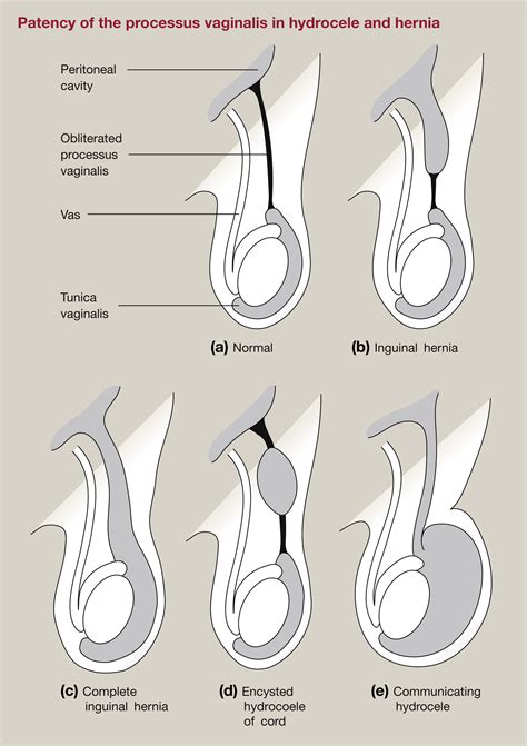 Congenital Inguinal Hernia Hydrocoele And Undescended Testis Surgery