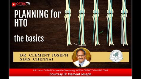 High Tibial Osteotomy Planning Get Your Hto Right Dr Clement Joseph