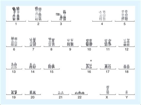 JLE Annales de Biologie Clinique Leucémie aiguë myéloïde avec