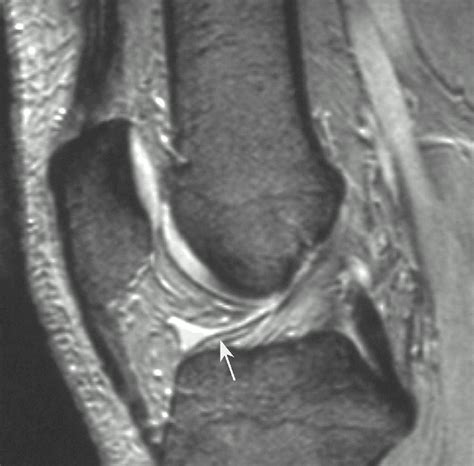 Anatomy And Mr Imaging Appearances Of Synovial Plicae Of The Knee Radiographics