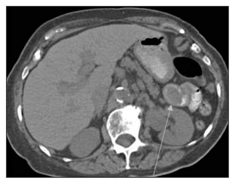 Jejunojejunal Intussusception By A Known Jejunal Adenocarcinoma CJS