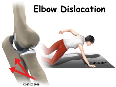 Physical Therapy in Columbia for Elbow Pain - Dislocation