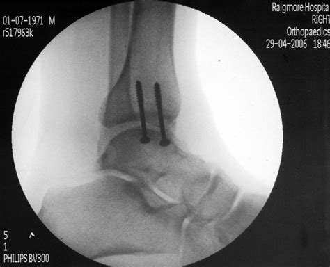 Parallel Screw Fixation Of The Medial Malleolus Download Scientific Diagram