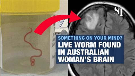 Live Worm Found In Australian Womans Brain Youtube