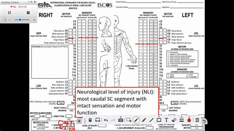 Classifying Spinal Cord Injuries Using Asia Scoring 46 Off