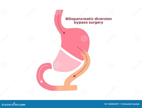 Biliopancreatic Diversion Bypass Surgery Stock Vector Illustration Of