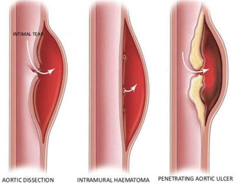 Aortic Dissection Intechopen