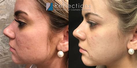 RF Microneedling For Acne Scars Results Super Charged Before After