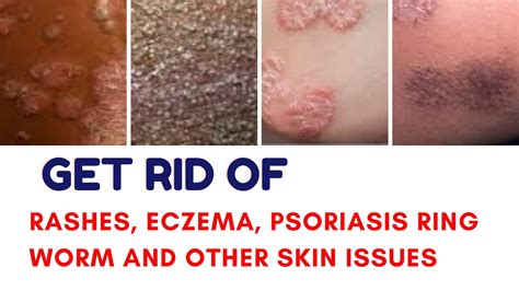 How To Get Rid Of Skin Rashes Eczema Psoriasis Ring Worm And Other