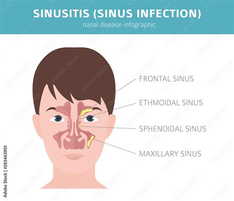 Nasal diseases. Sinusitis, sinus infection diagnosis and treatment ...