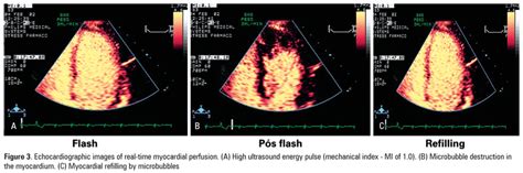 SciELO Brasil Ecocardiografia contraste no infarto do miocárdio